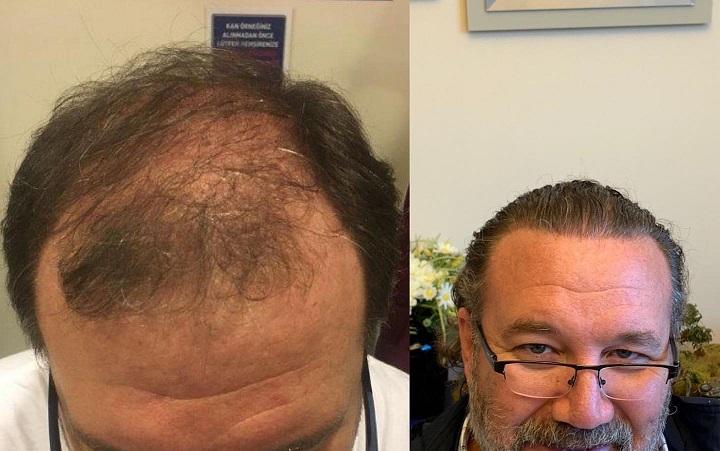 Cuántos pelos tiene un foliculo?